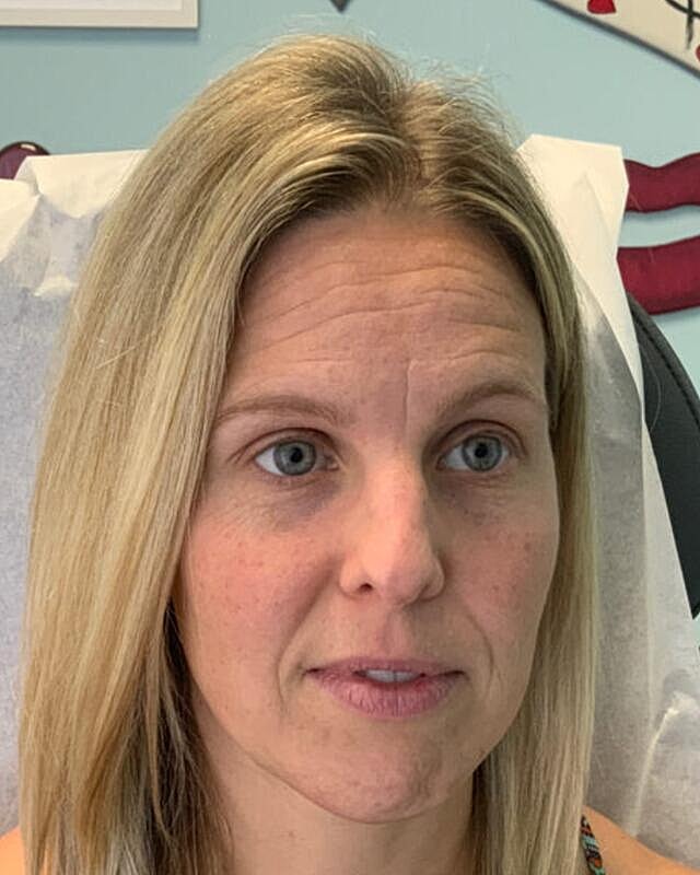 Injectables Before & After