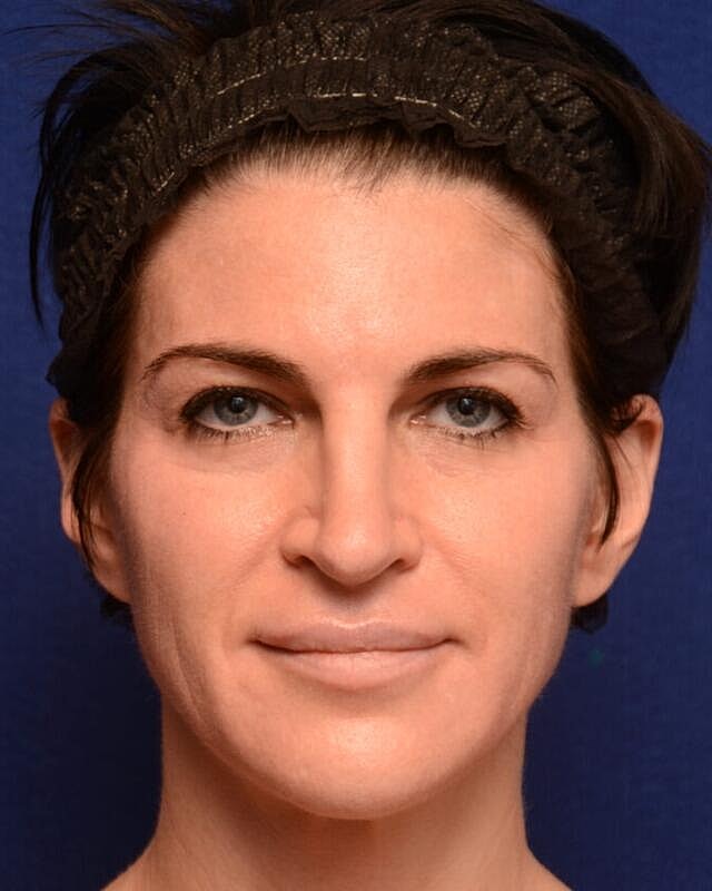 Injectables Before & After