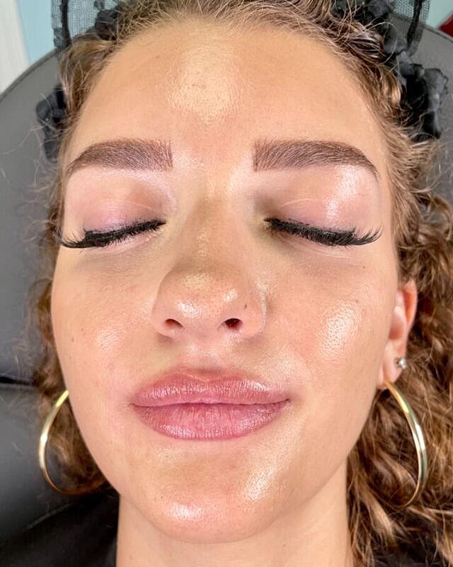 Injectables Before & After