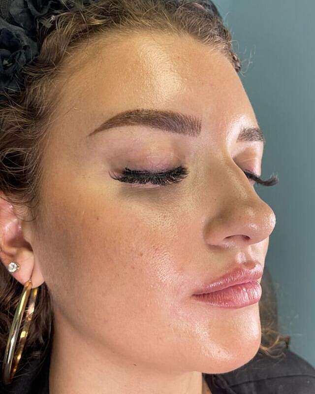 Injectables Before & After