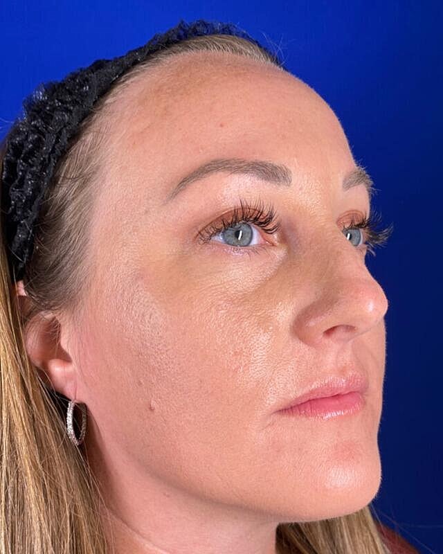 Injectables Before & After