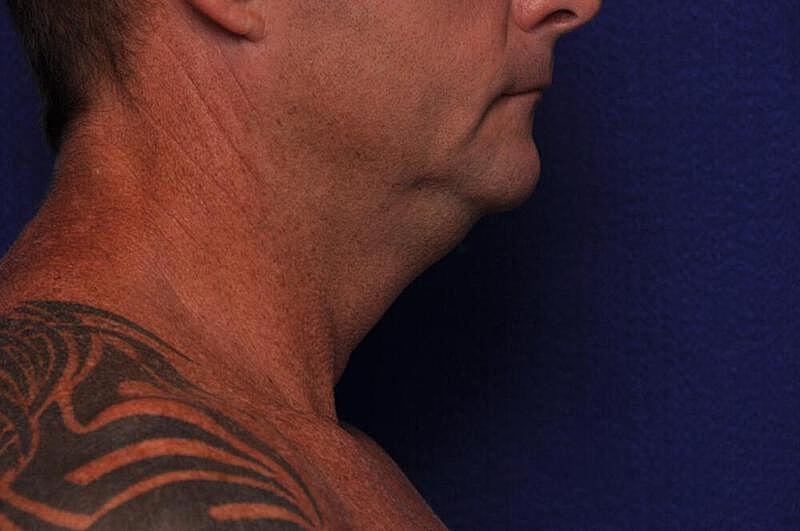 Kybella Before & After