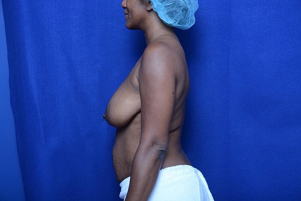 Mommy Makeover Before & After