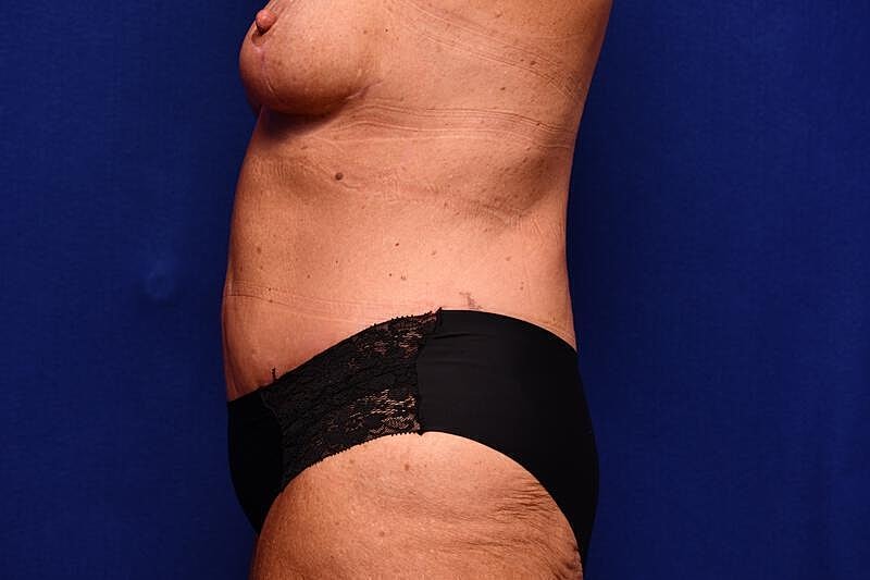 Tummy Tuck Before & After