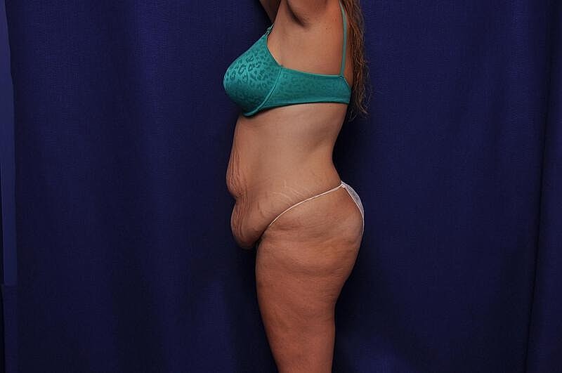 Tummy Tuck Before & After