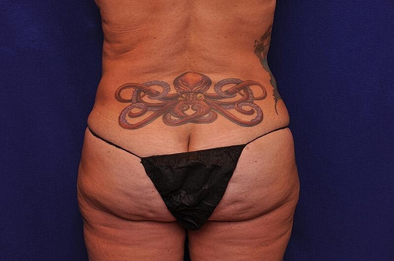 Tummy Tuck Before & After