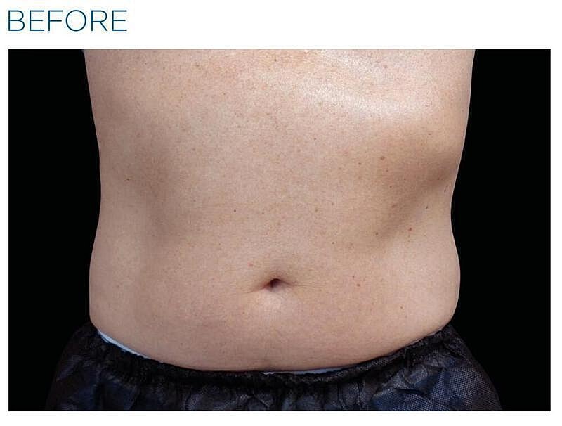 Emsculpt Abdomen Before & After
