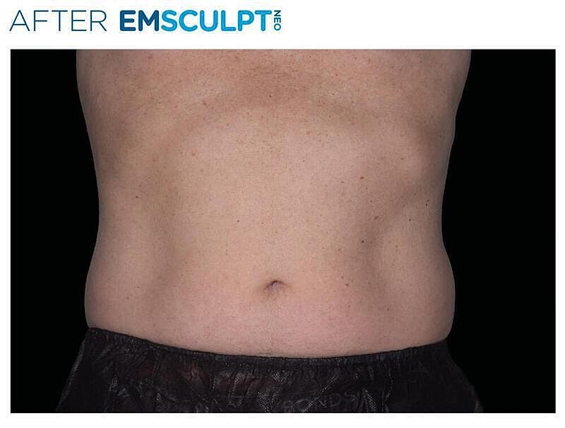 Emsculpt Abdomen Before & After
