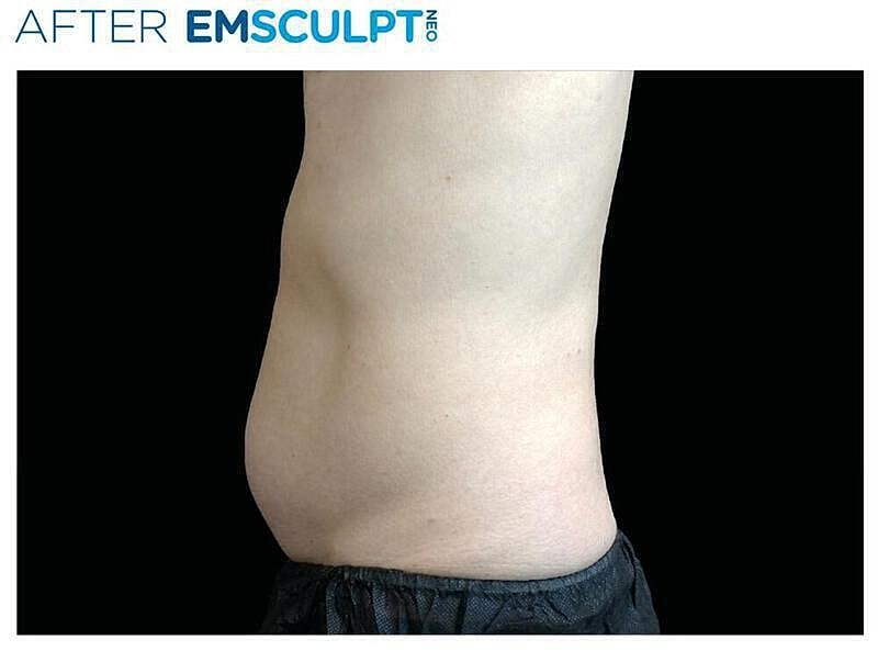 Emsculpt Abdomen Before & After