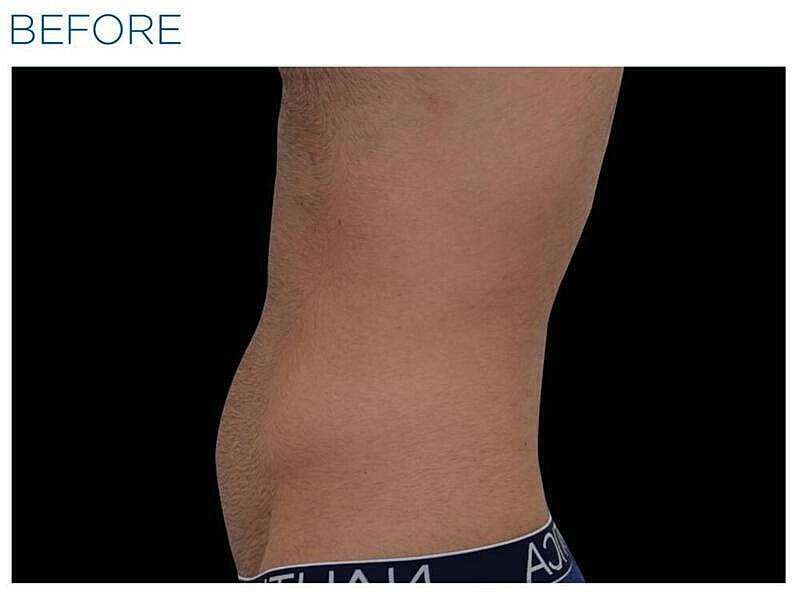 Emsculpt Abdomen Before & After