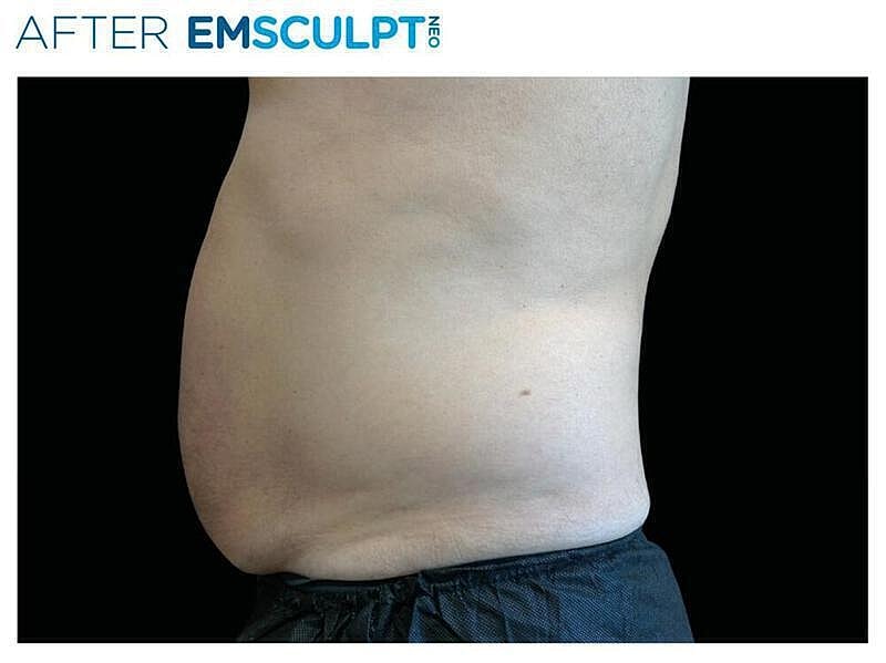 Emsculpt Abdomen Before & After