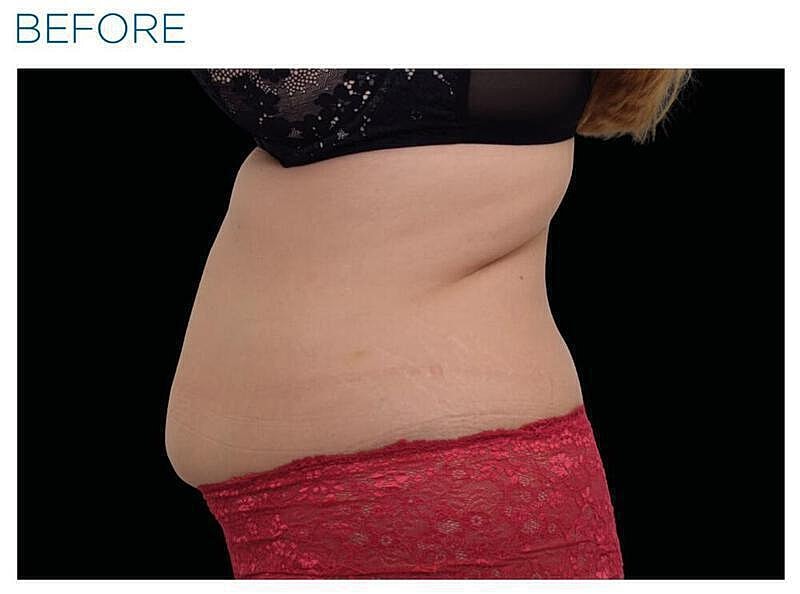 Emsculpt Abdomen Before & After