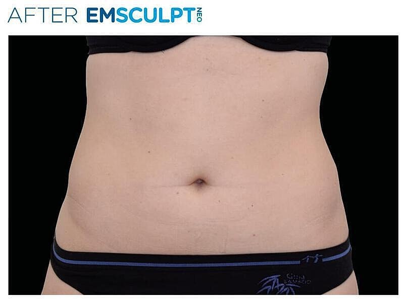 Emsculpt Abdomen Before & After