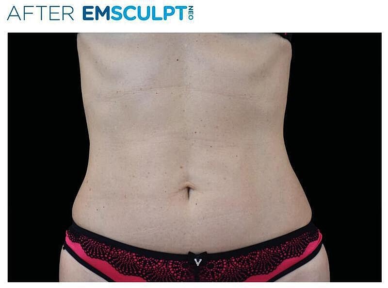 Emsculpt Abdomen Before & After