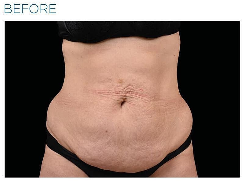 Emsculpt Abdomen Before & After
