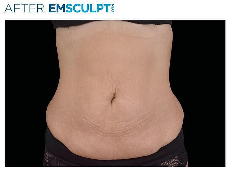Emsculpt Abdomen Before & After