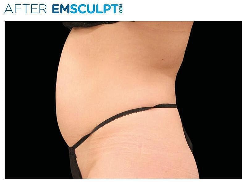 Emsculpt Abdomen Before & After