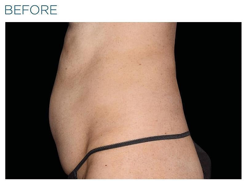 Emsculpt Abdomen Before & After