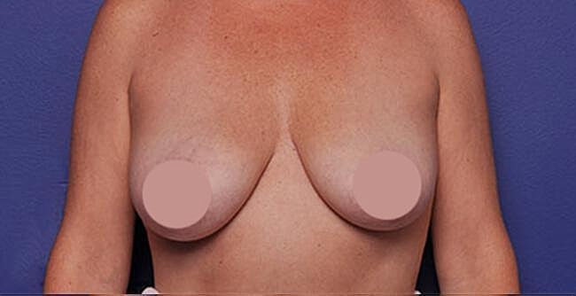 Breast Lift Before & After