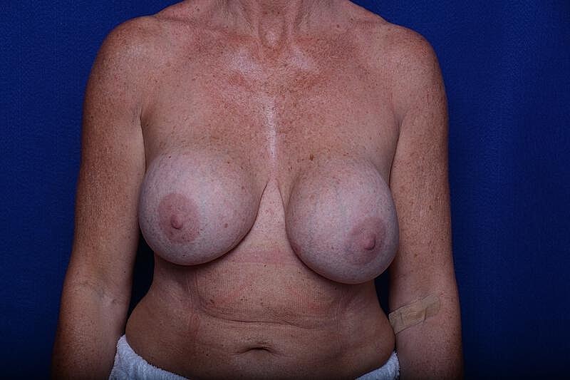 Breast Lift Before & After