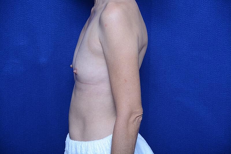 Breast Augmentation Before & After