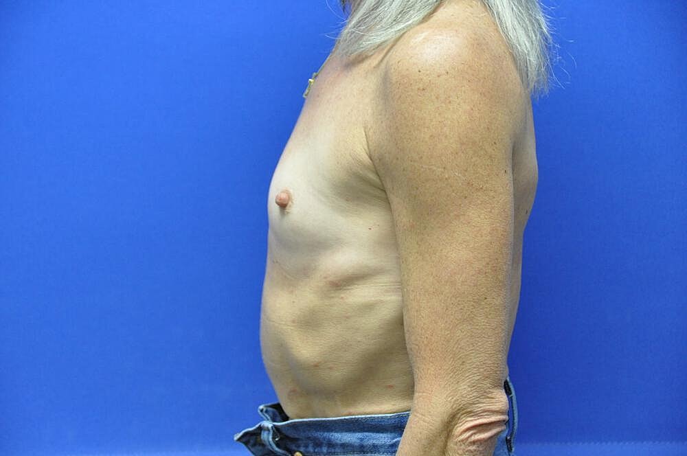 Breast Augmentation Before & After