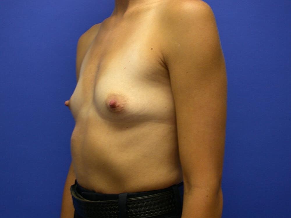 Breast Augmentation Before & After