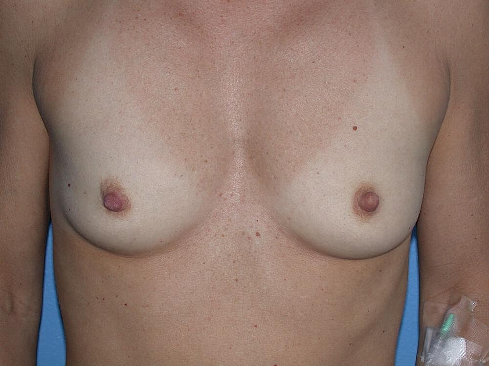 Breast Augmentation Before & After