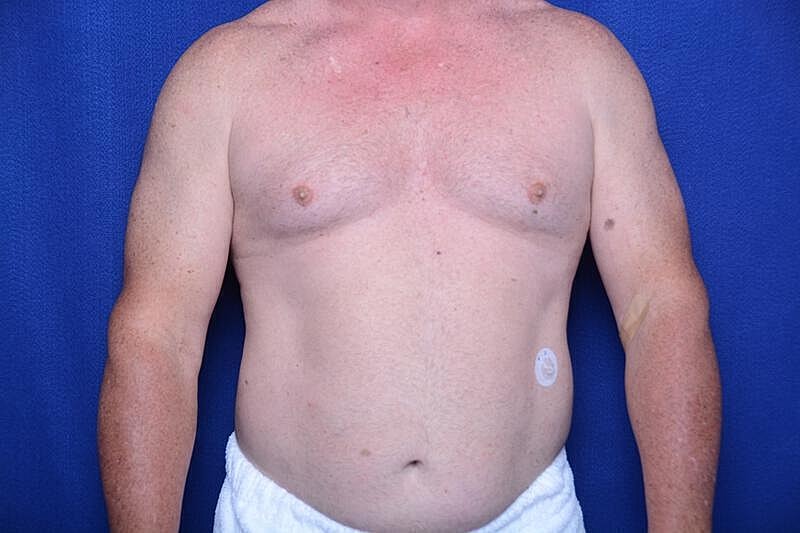 Gynecomastia Surgery Before & After