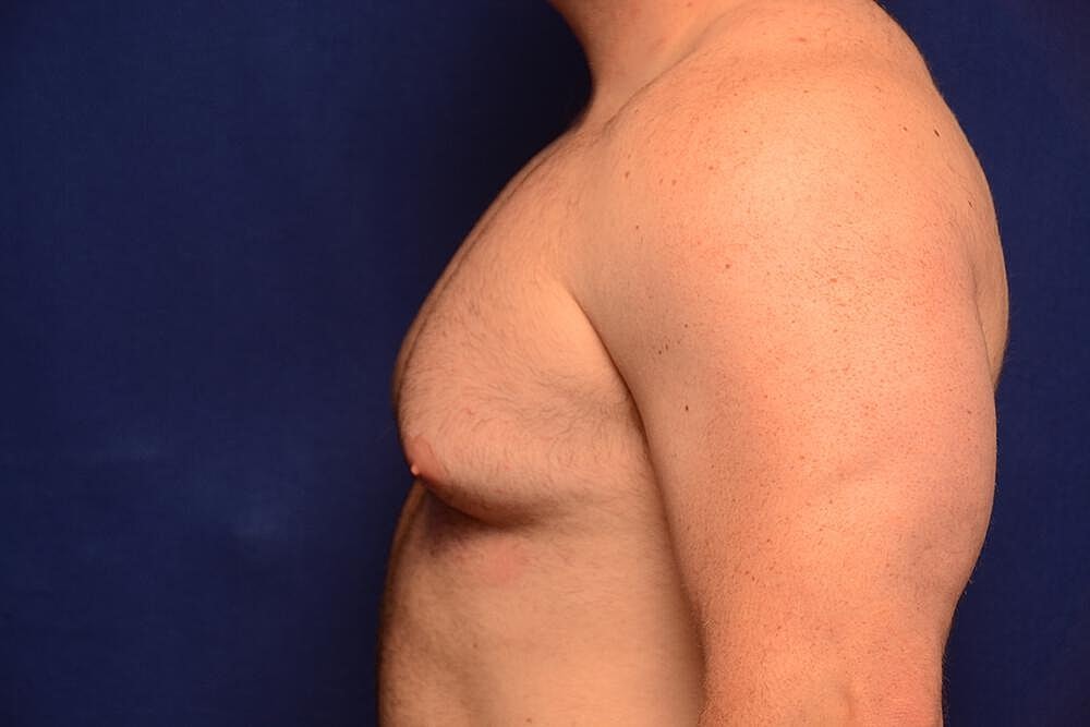 Gynecomastia Surgery Before & After