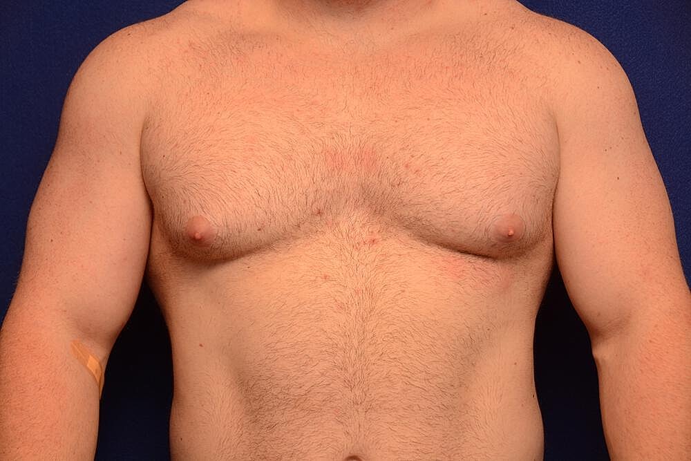 Gynecomastia Surgery Before & After