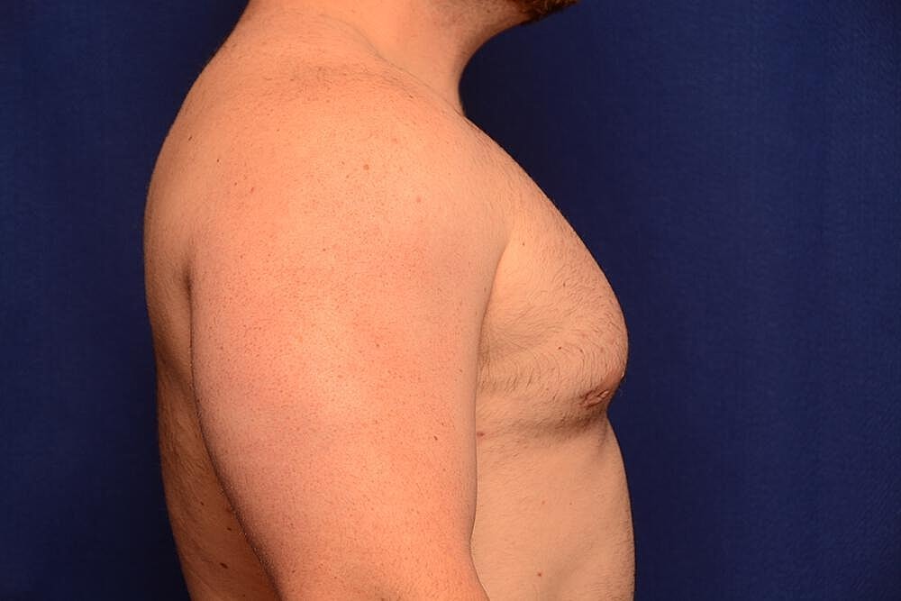 Gynecomastia Surgery Before & After
