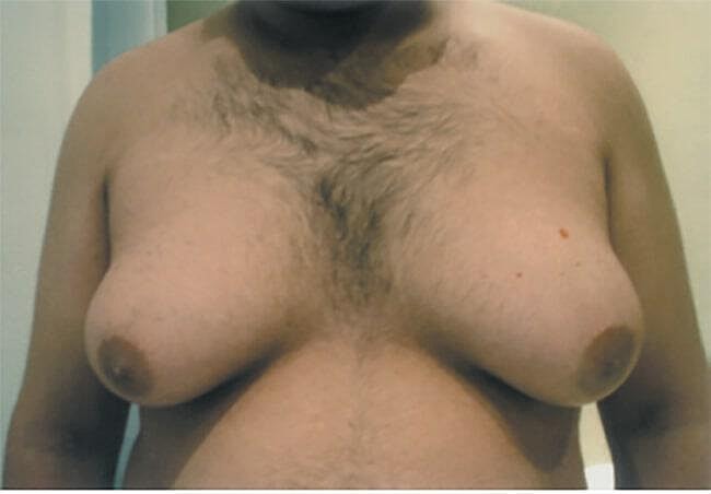 Gynecomastia Surgery Before & After
