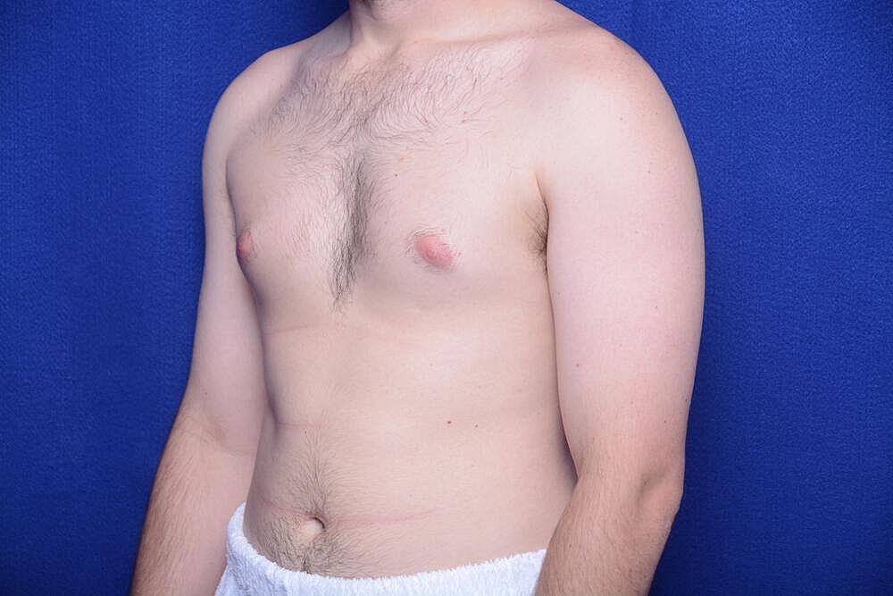 Gynecomastia Surgery Before & After
