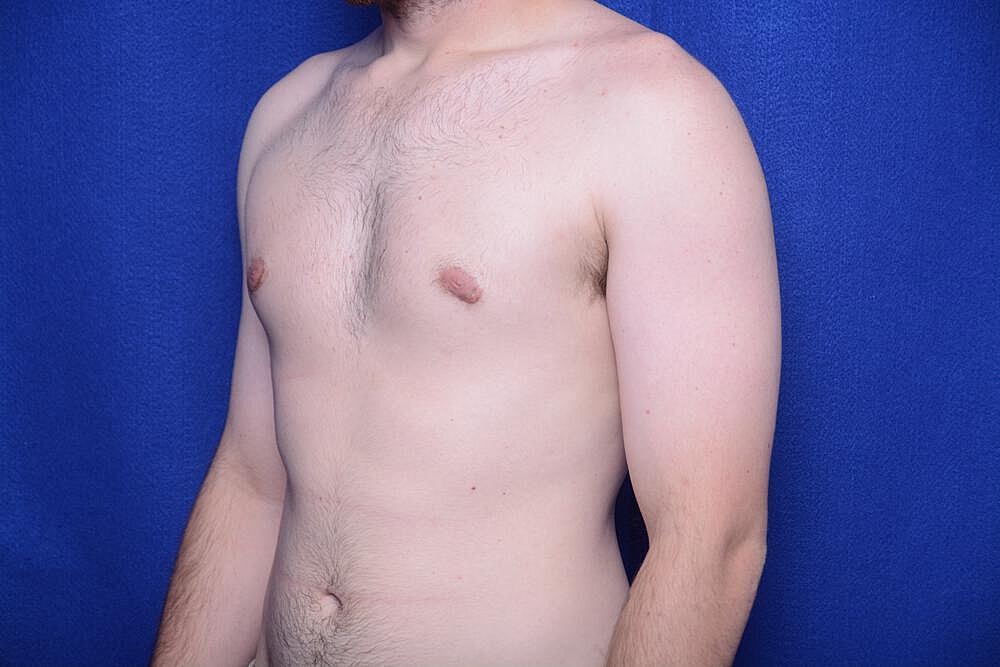 Gynecomastia Surgery Before & After