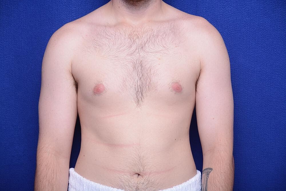 Gynecomastia Surgery Before & After