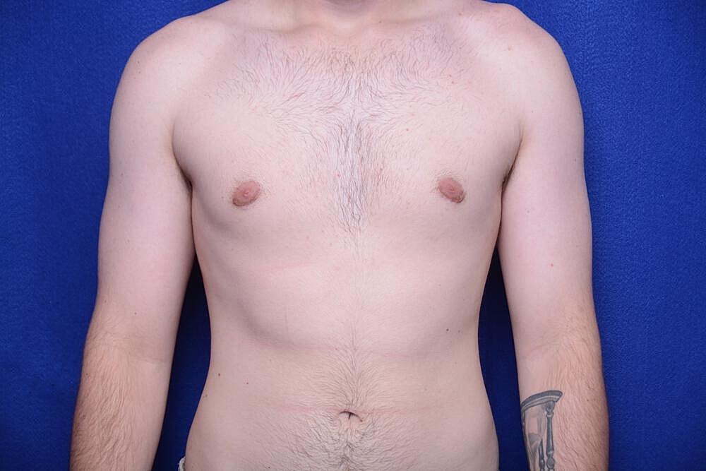 Gynecomastia Surgery Before & After