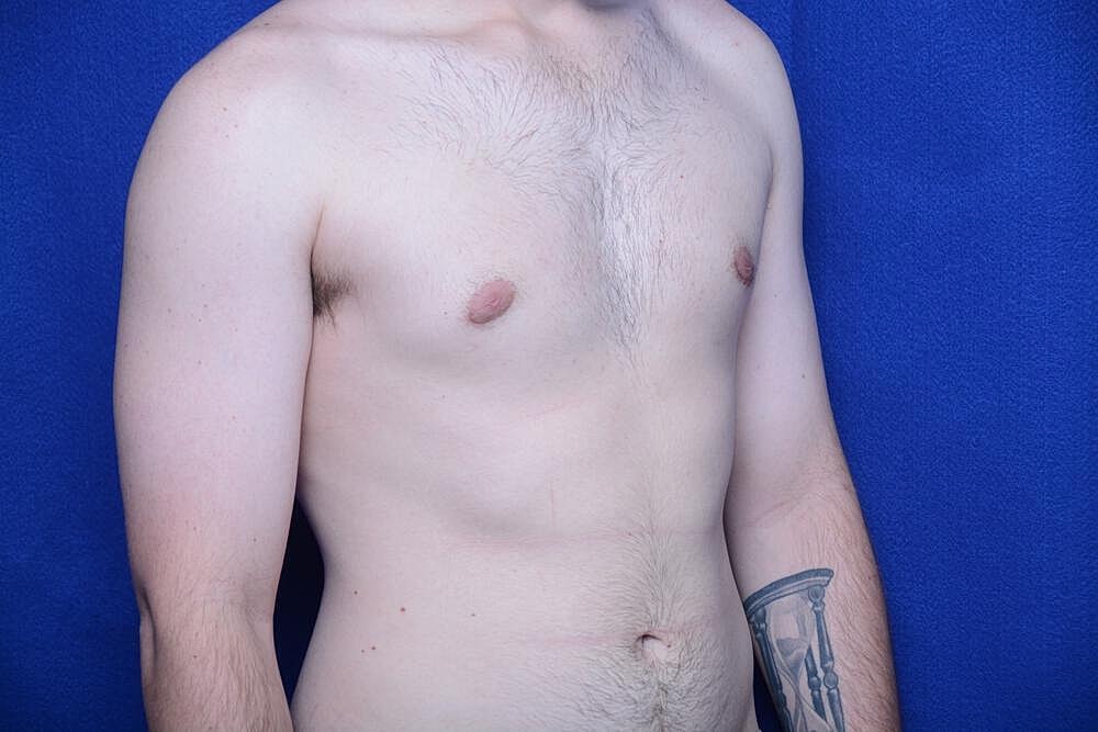 Gynecomastia Surgery Before & After