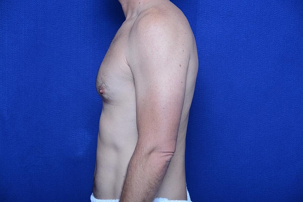 Gynecomastia Surgery Before & After
