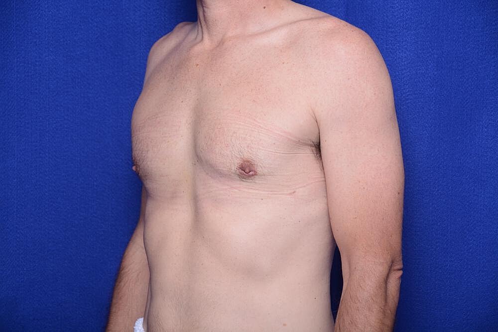 Gynecomastia Surgery Before & After