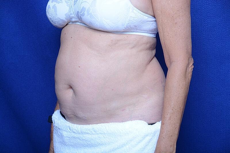 Liposuction Before & After