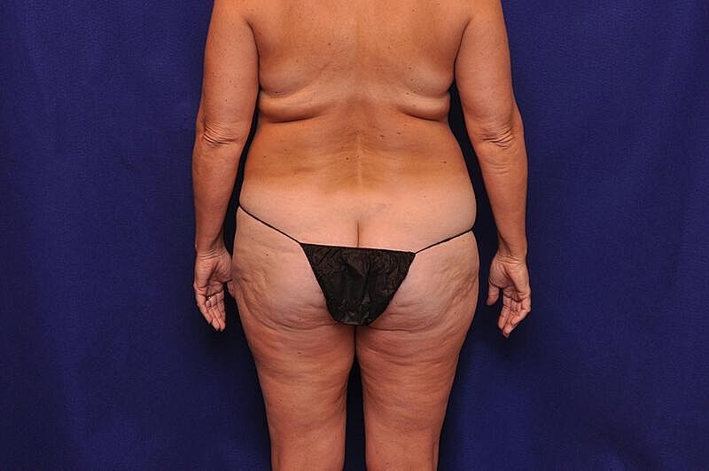 Liposuction Before & After