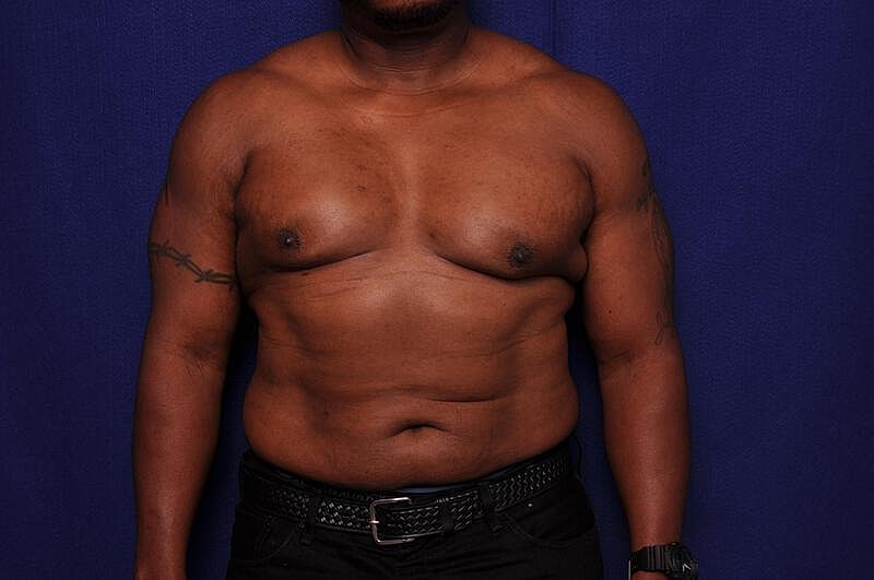 Liposuction Before & After