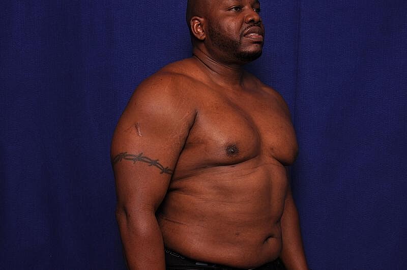 Liposuction Before & After