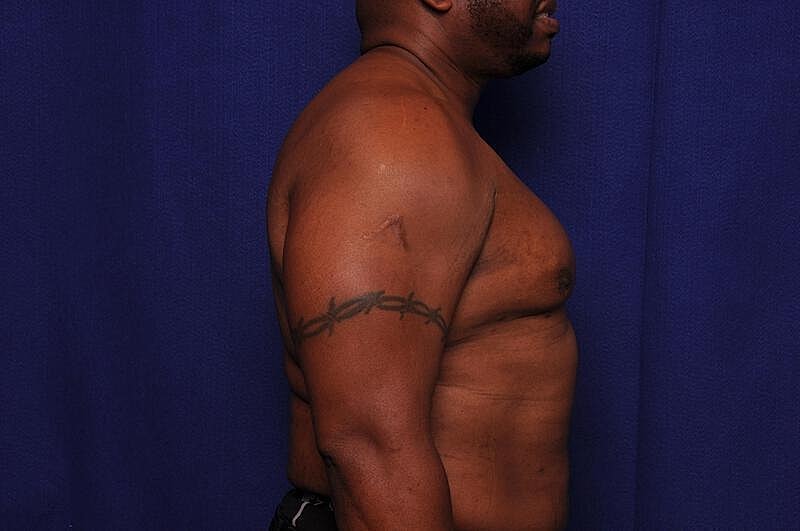 Liposuction Before & After