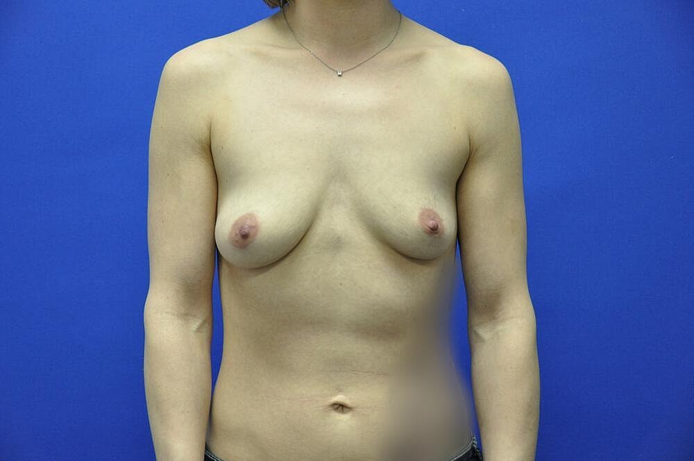 Athletic Breast Augmentation Before & After