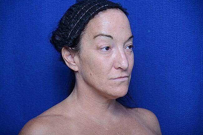 Fat Transfer To Lips Before & After