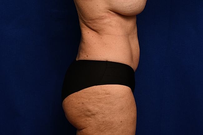 Semaglutide Before & After