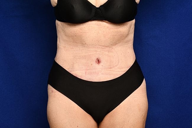 Semaglutide Before & After