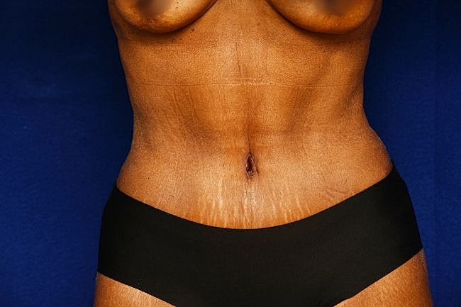 Semaglutide Before & After